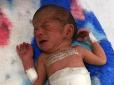 В Індії народилась дитина з двома головами (фото)